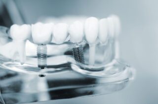 Dental implants can benefit patients with missing teeth. However, they may not be the right treatment for everyone.